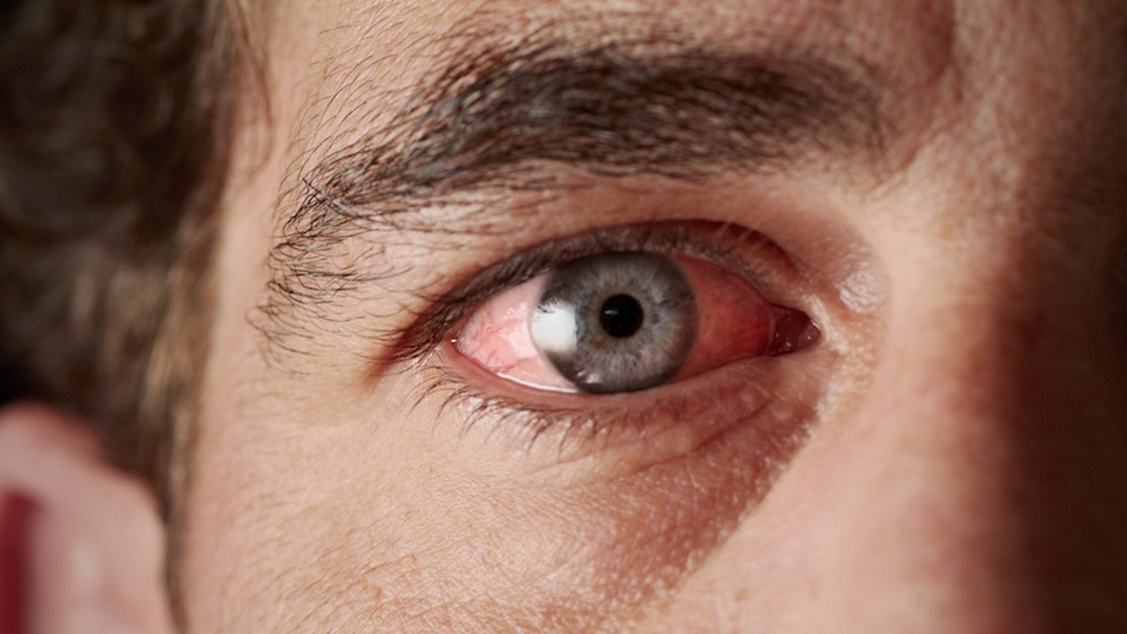 Natural Home Remedies For Pink Eye (Conjunctivitis)