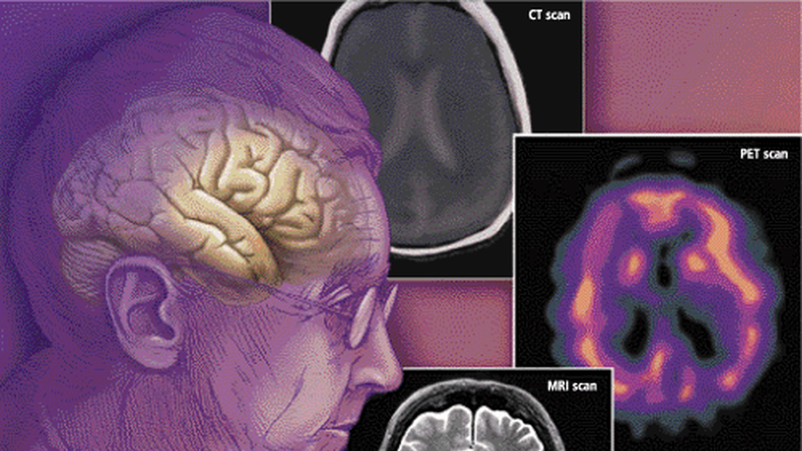 There's Nothing Natural About Drug-Induced Dementia